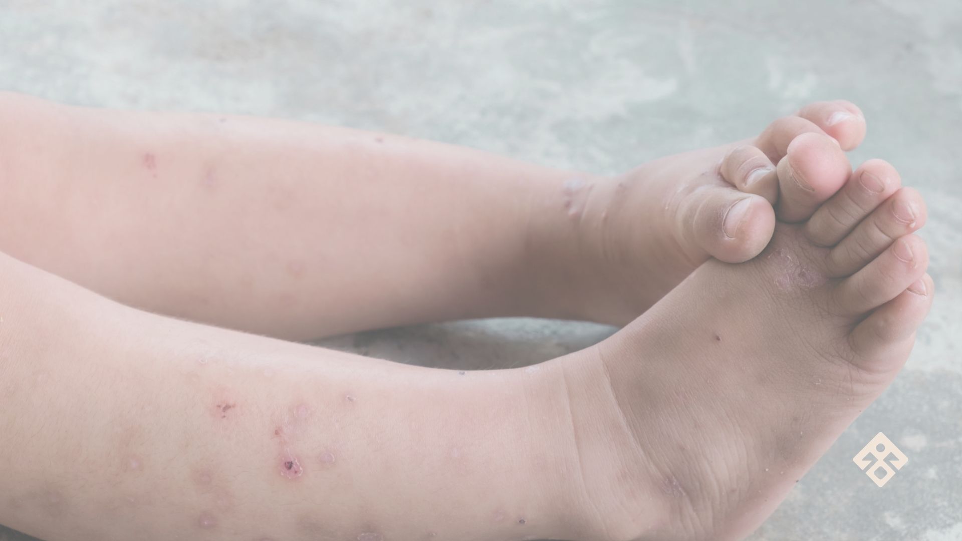 Visible eczema on a child’s legs—commonly seen in cases of childhood eczema and gut health imbalance.